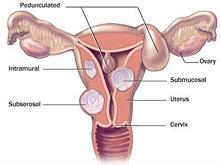 Миома матки грозит повторными выкидышами, показал анализ
