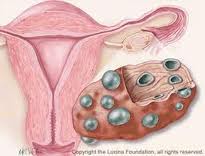 Женщины с синдромом поликистозных яичников подвергаются высокому риску развития тромбозов