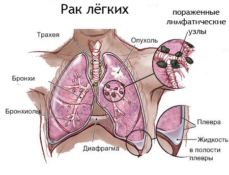 Хронические болезни легких не всегда провоцируют развитие рака