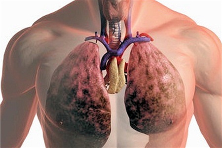 Найдена причина рака легких у некурящих