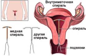 Внутриматочные противозачаточные средства