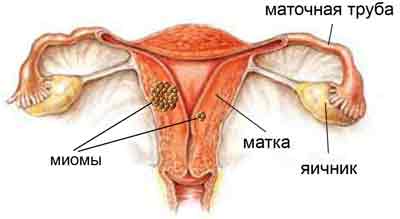 Миома матки: причины возникновения, симптомы, диагностика и лечение