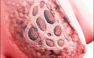 6 мифов о раке груди