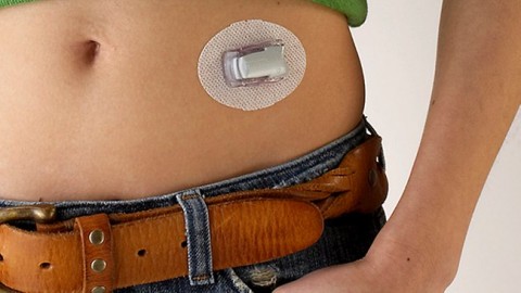 Страдающие диабетом могут обзавестись искусственной поджелудочной железой