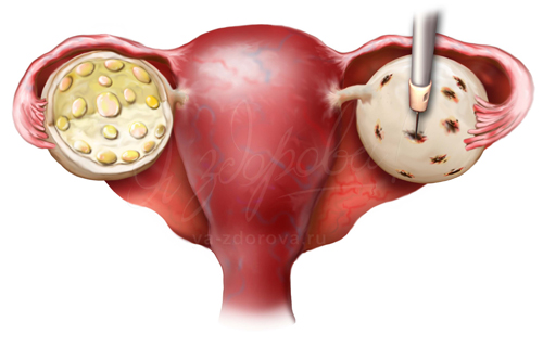 Поликистоз яичников: что это такое и как его лечить
