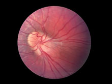 Врачи нашли новый способ восстановить зрение у пациентов с диабетической ретинопатией