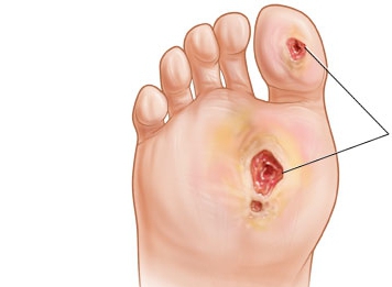 Диабетическая стопа