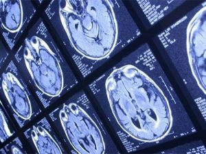Излучающий ультразвук имплантат может помочь больным раком мозга