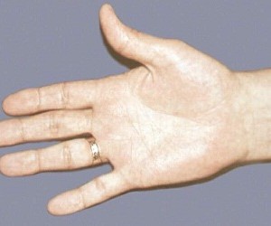 Рука человека отражает наличие скрытно развивающегося рака